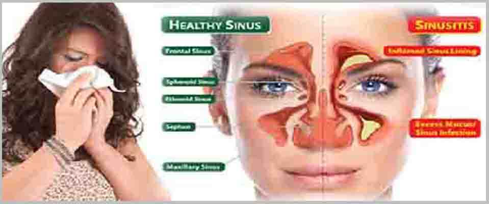 Sinusitis